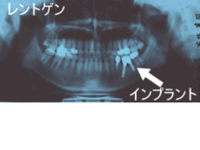 インプラント レントゲン写真