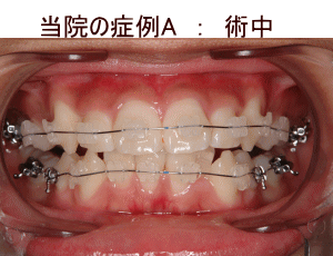 歯科矯正　術前