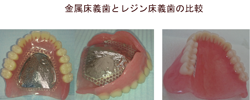 金属床義歯とレジン床義歯